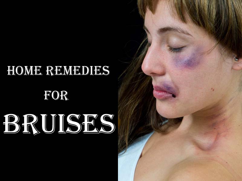 14 Best Home Remedies for Bruises: How Do They Work? | I Fashion Styles