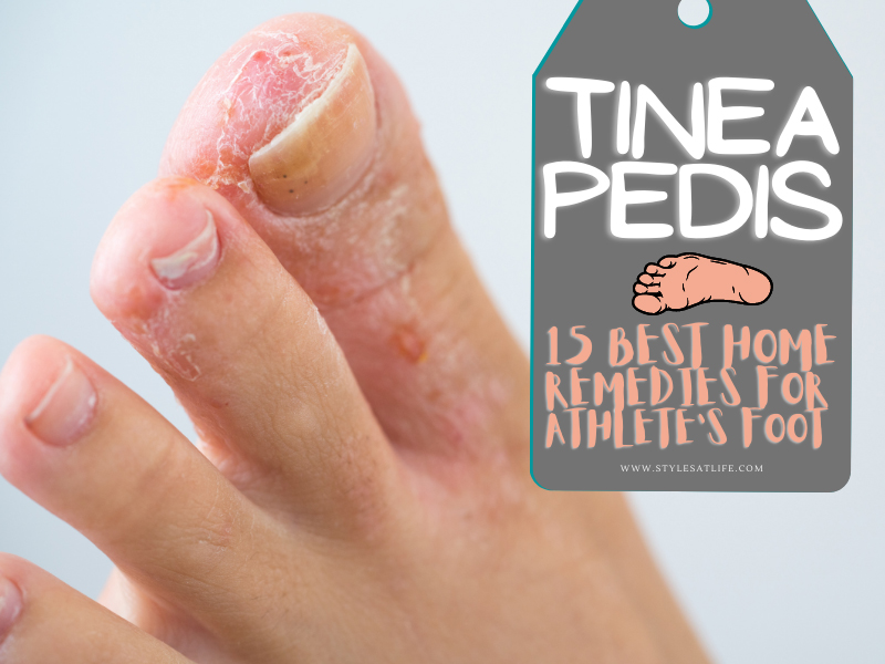 15 Best Home Remedies for Athlete's Foot (Tinea Pedis)