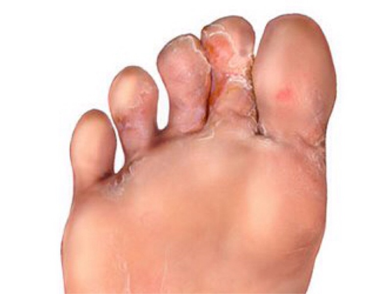 15 Best Home Remedies for Athlete's Foot (Tinea Pedis)