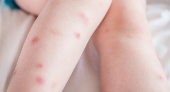 Kill Bed Bugs: 10 Home Remedies to Treat Khatmal Bites