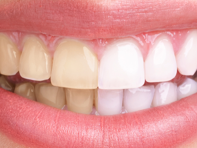 Yellow Teeth: 20 Best Home Remedies for Teeth Discoloration