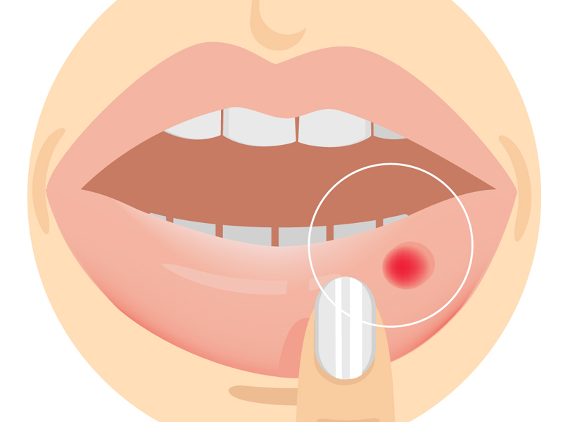 Canker Sores: 25 Best Home Remedies for Mouth Ulcers