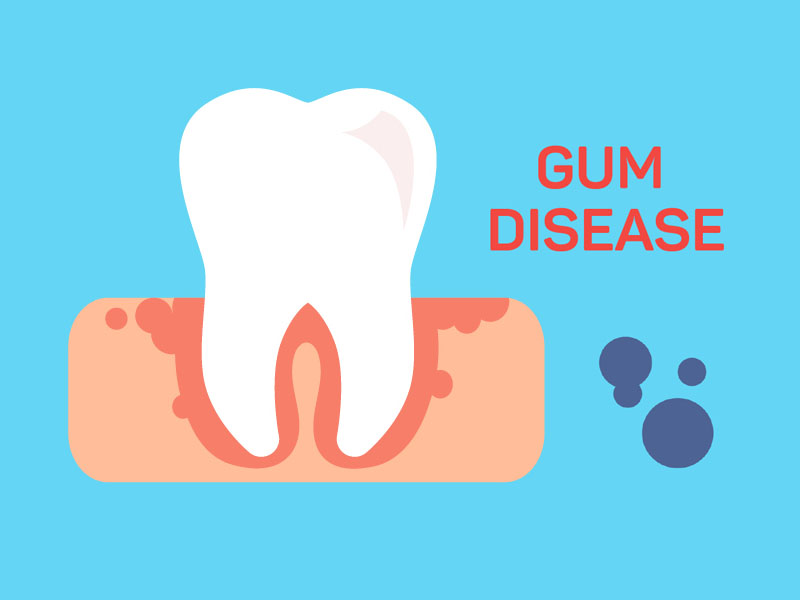 Periodontitis: 25 Natural Ways to Treat Gingivitis at Home