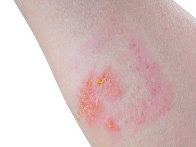 25 Best and Quick Home Remedies For Poison Ivy Rash