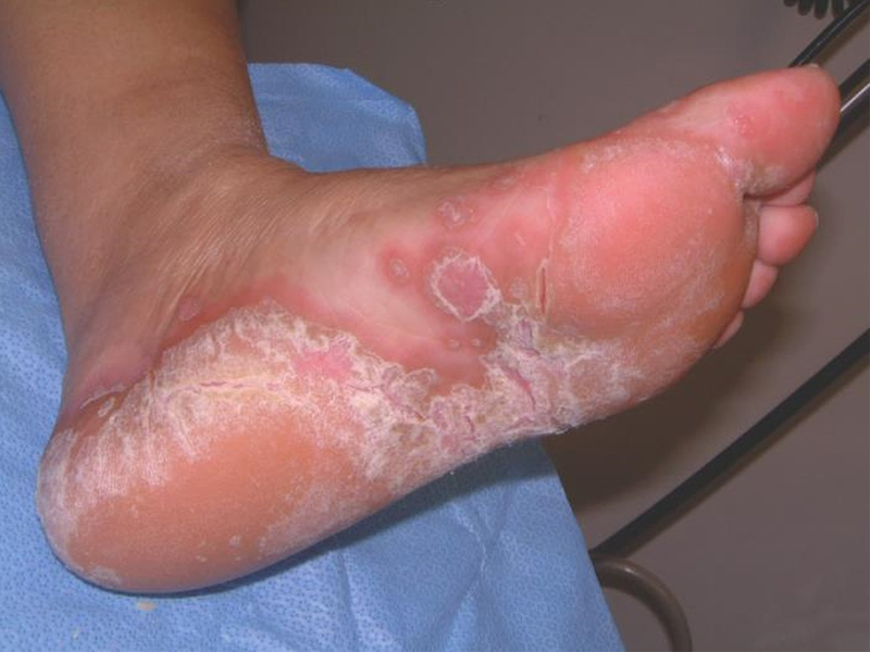 15 Natural and Best Home Remedies For Fungal Infections