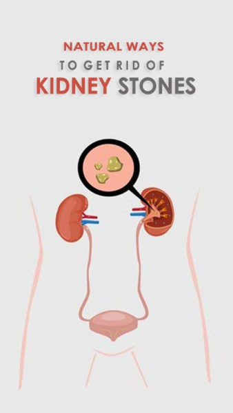 20 Best Indian Home Remedies For Kidney Stones At Home
