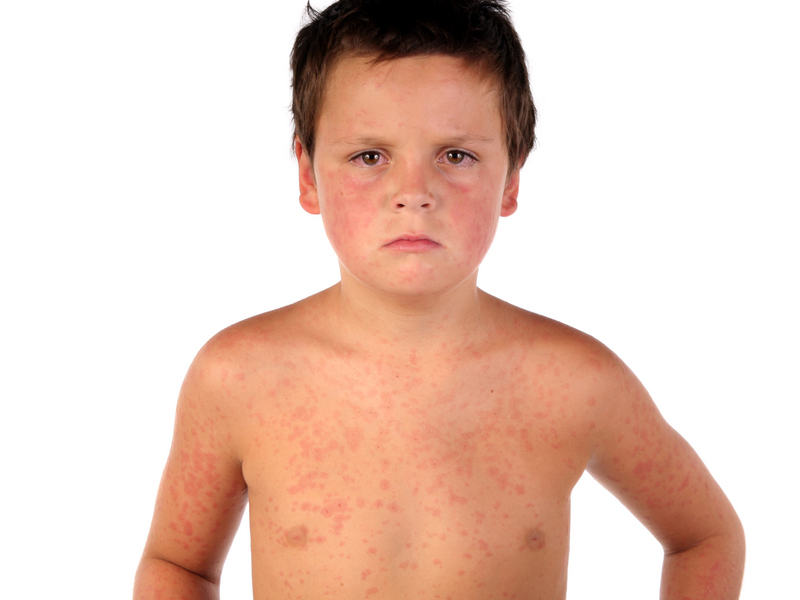 Chicken pox (Varicella): Signs, Symptoms, Causes and Complications.