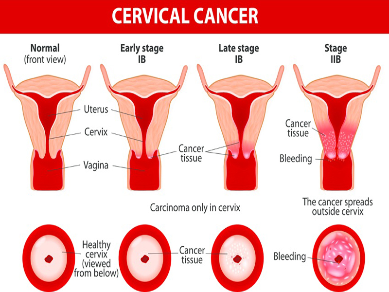 Cervical Cancer Symptoms And Causes | I Fashion Styles