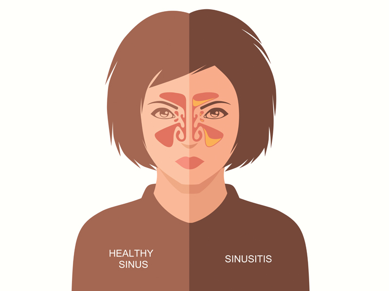 Sinus Symptoms And Causes | I Fashion Styles
