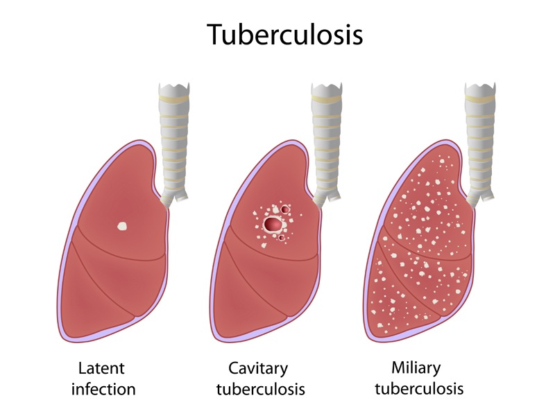 Tuberculosis (TB) Symptoms And Causes | I Fashion Styles