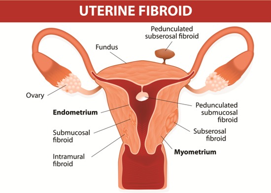 Symptoms of Fibroids | I Fashion Styles