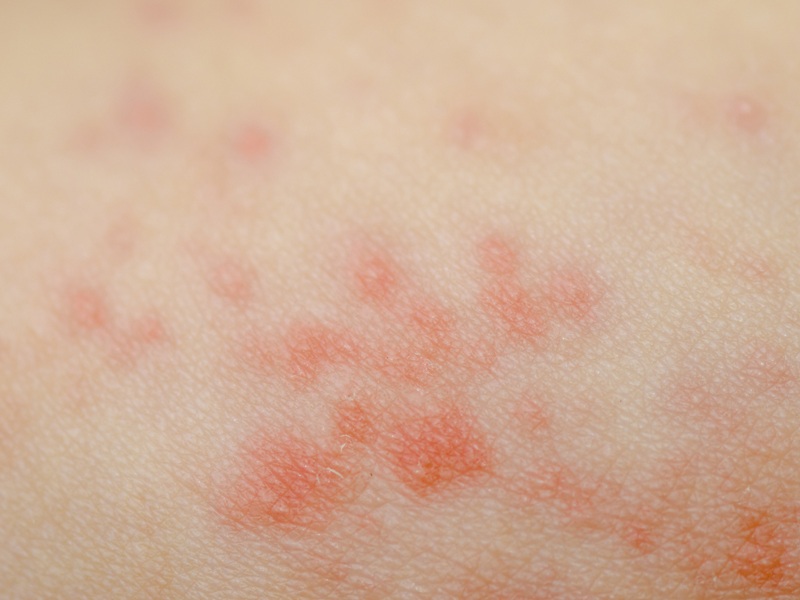Eczema Symptoms and Causes | I Fashion Styles