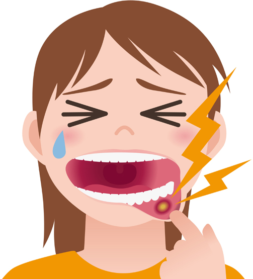 Mouth Ulcer Causes And Symptoms | I Fashion Styles