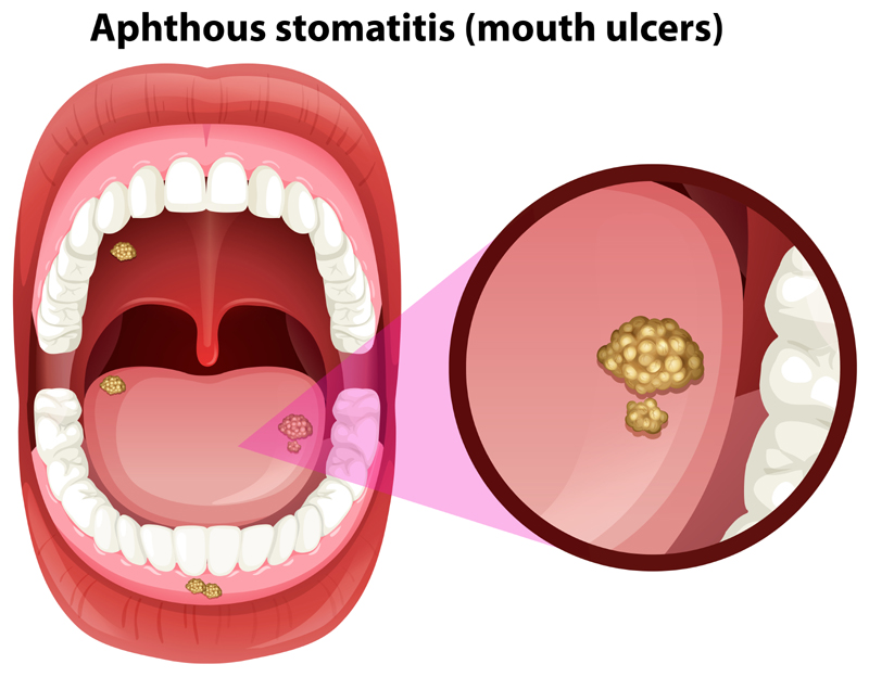 Mouth Ulcer Causes And Symptoms | I Fashion Styles
