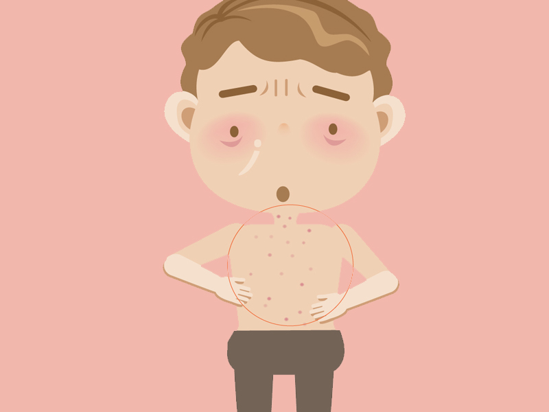 Causes And Symptoms Of Typhoid Fever | I Fashion Styles