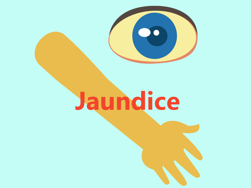 Top 20 Causes and Symptoms of Jaundice | I Fashion Styles