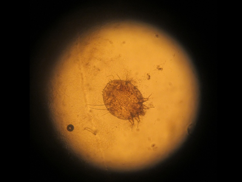 4 Common Symptoms of Scabies in Adults and Children