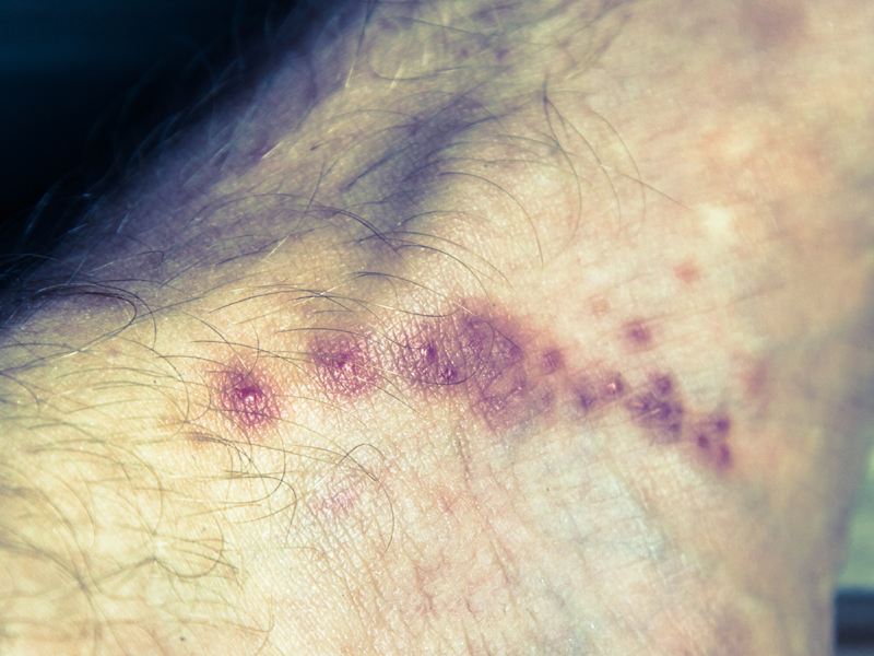 4 Common Symptoms of Scabies in Adults and Children