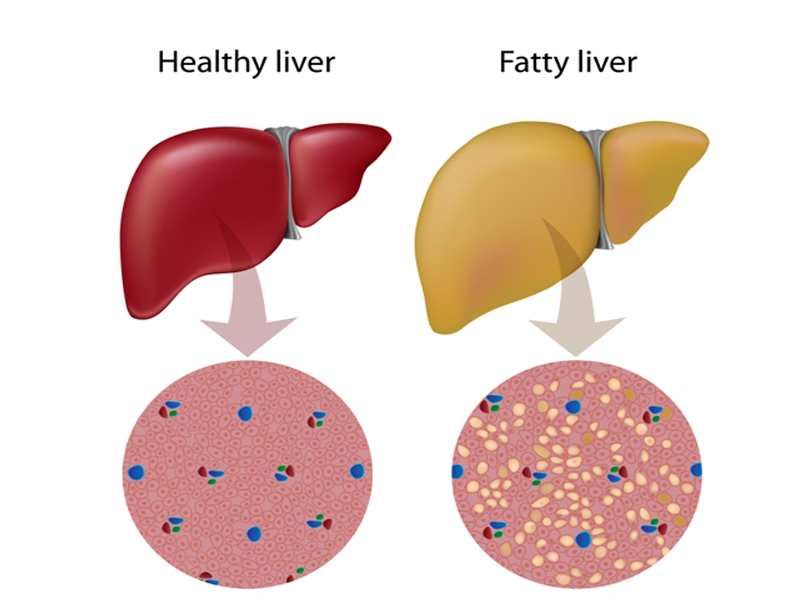 Fatty Liver: Symptoms, Causes and Effects (NAFLD &amp; AFLD)