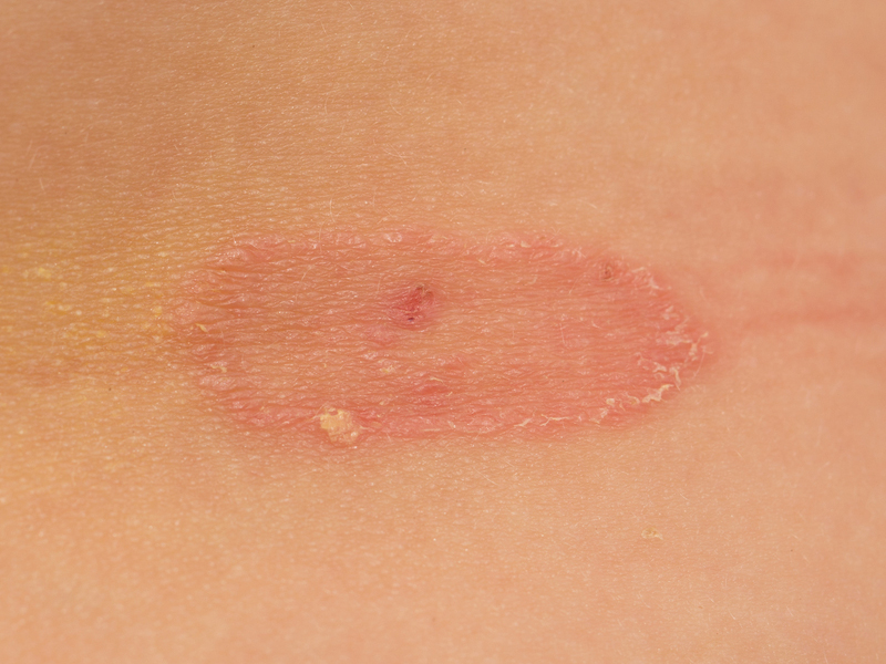 What Are The Main Causes and Symptoms of Candida