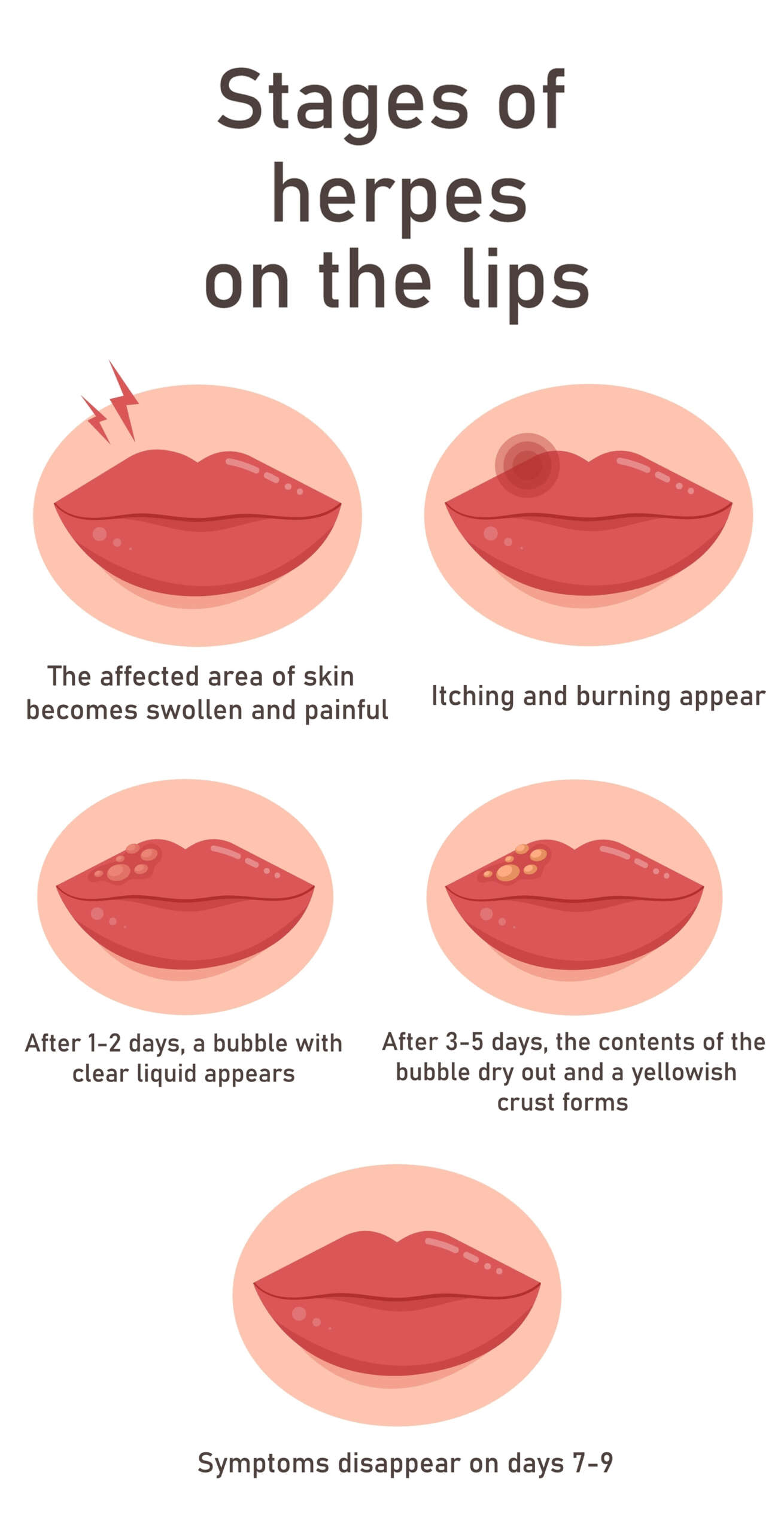 Know the Causes and Early Symptoms of Herpes | I Fashion Styles