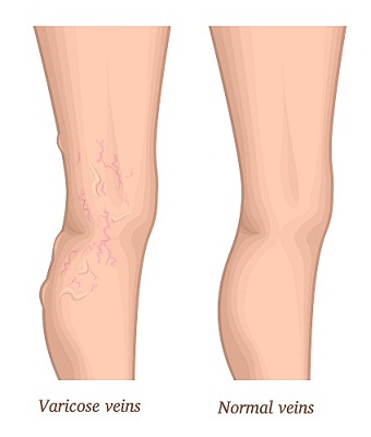 Varicose Veins During Pregnancy: A Complete Informatory Guide!