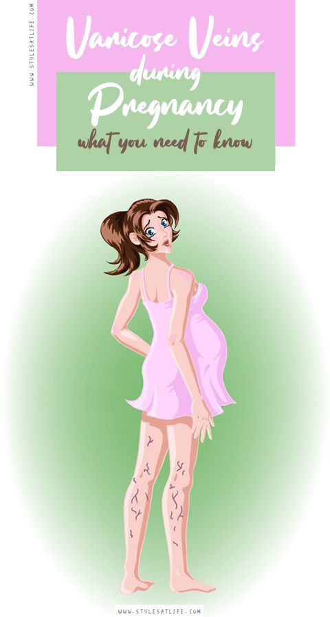 Varicose Veins During Pregnancy: A Complete Informatory Guide!