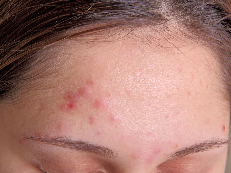 Pimples During Pregnancy: 5 Best Natural Treatments